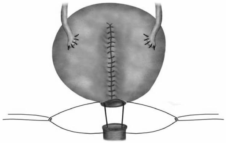 Yapay Mesane Ameliyatı Yapan Doktorlar