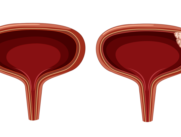 Mesane Kanseri Progresyonu Ne Demek?