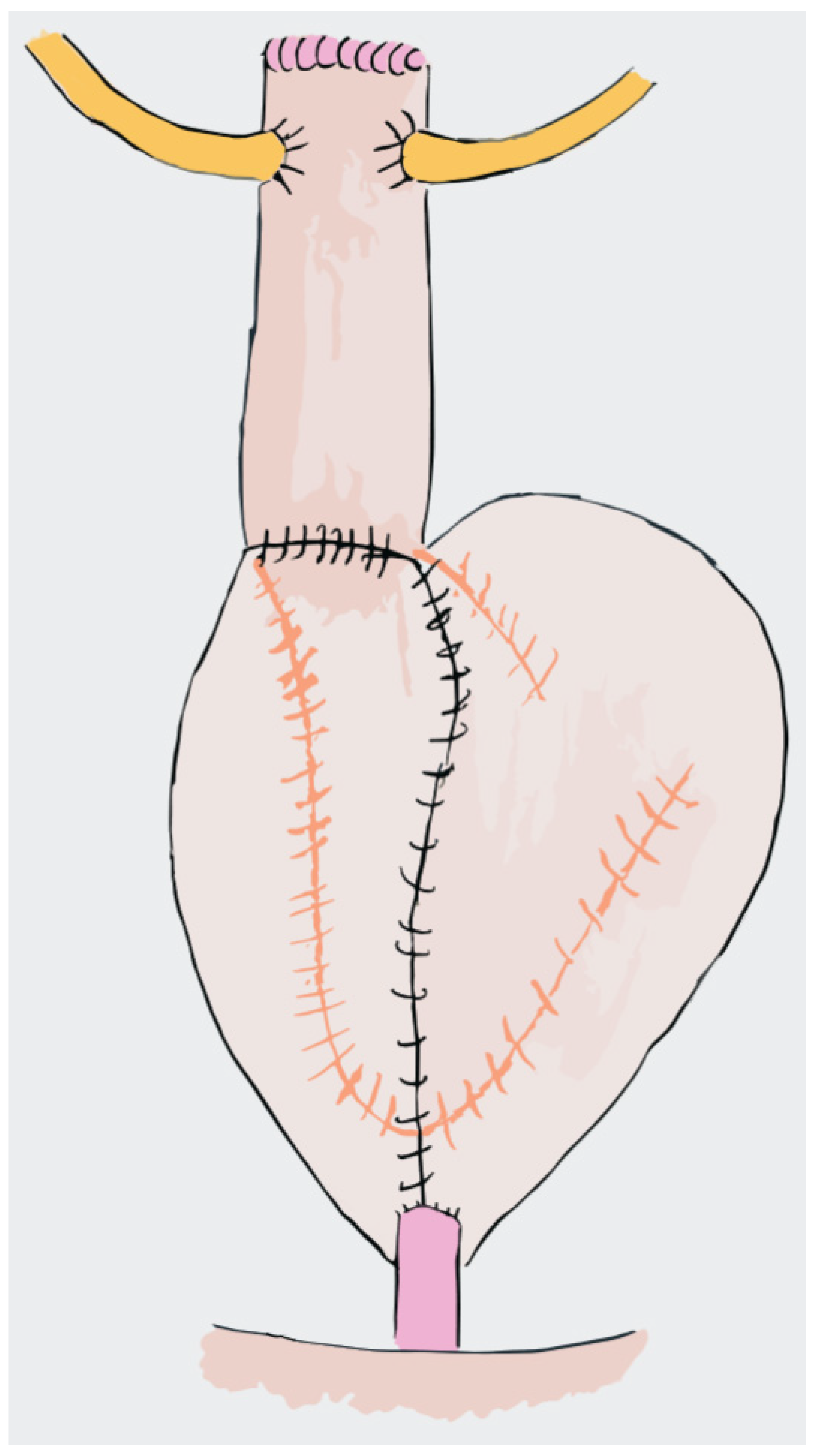 Yapay Mesane İle Doğal Mesane Arasındaki Farklar