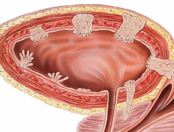 Yüzeyel Mesane Kanseri Nedir?