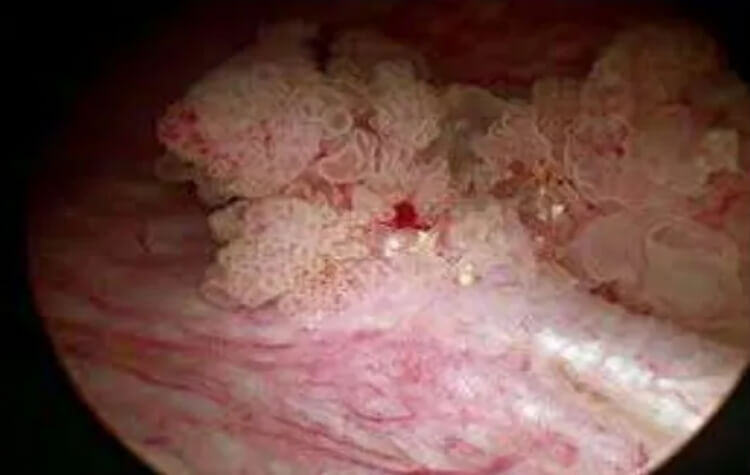 İntravezikal BCG Tedavisi