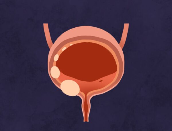 Evre 0 Mesane Kanseri