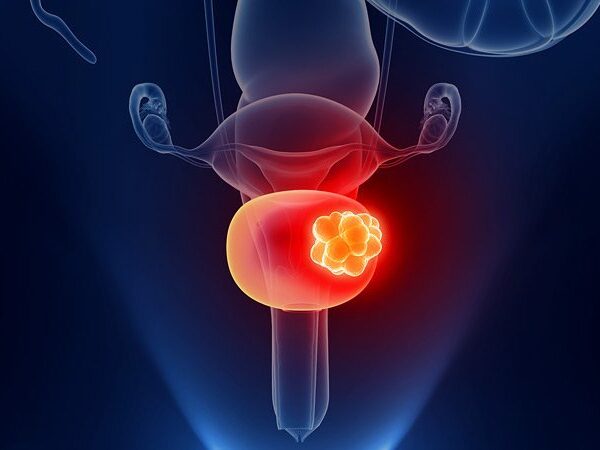 Amerika’da Mesane Kanseri Tedavisi