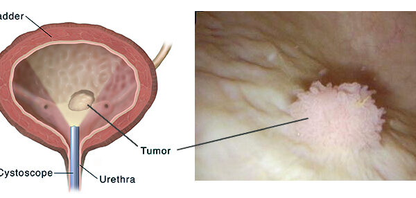 En İyi Huylu Mesane Kanseri Türü Hangisidir?