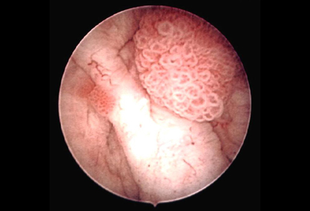 Evre 1 Mesane Kanseri