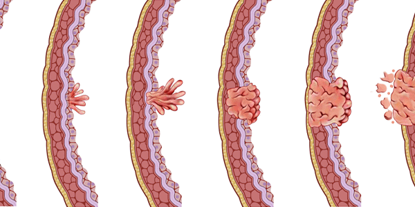 Evre 2 Mesane Kanseri