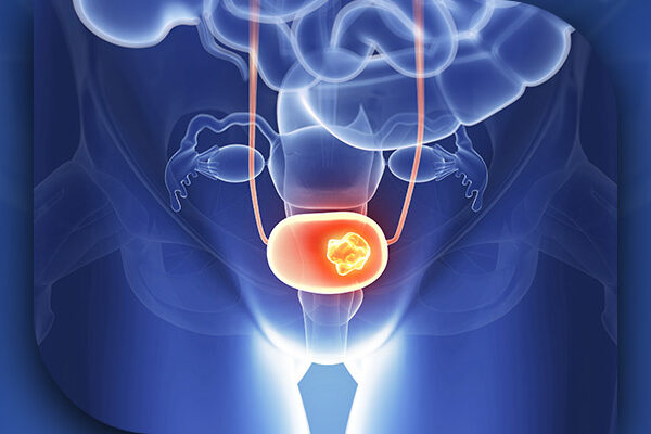 Evre 3 Mesane Kanseri