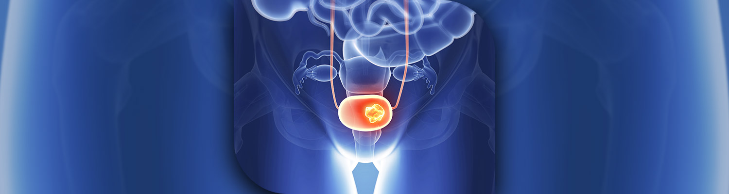 Evre 3 Mesane Kanseri