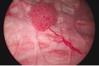 İdrardan Kan Gelmesi