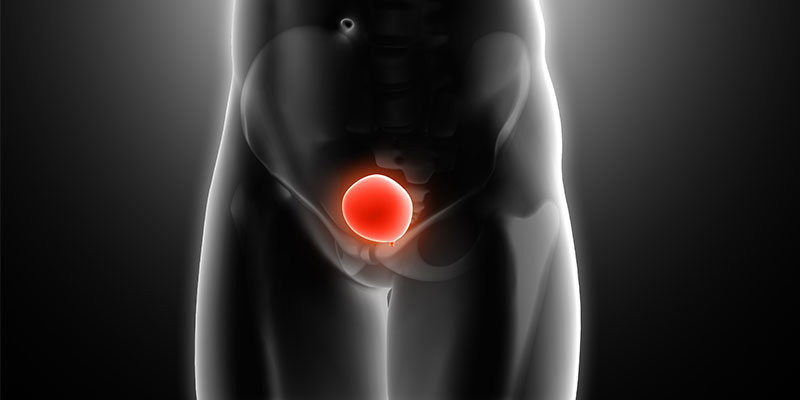 Kadınlarda Yapay Mesane