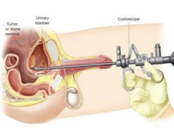 Kapalı Mesane Tümörü Ameliyatı