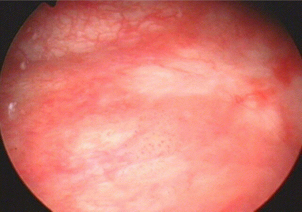 Mesane Kanseri Karsinoma in Situ (CİS)