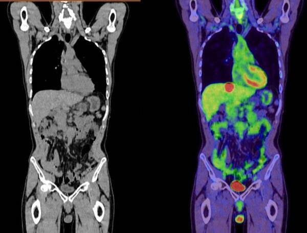 Mesane Kanseri PET CT
