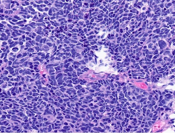 Mesanenin Küçük Hücreli Nöroendokrin Karsinomu