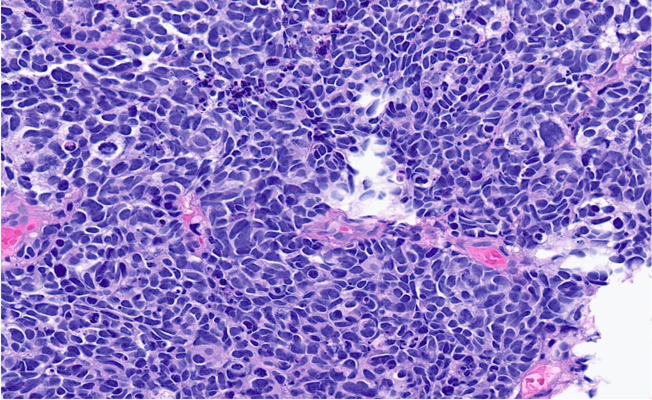 Mesanenin Küçük Hücreli Nöroendokrin Karsinomu