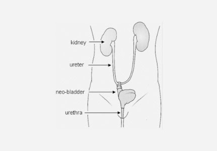 Ortotopik Neobladder (Yapay Mesane)
