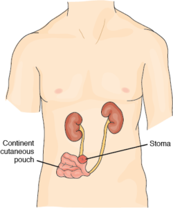 Yapay Mesane Devlet Karşılıyor Mu?