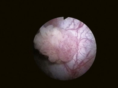 Evre 0 Mesane Kanseri Tedavisi