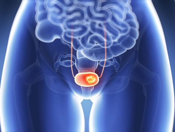 Kadınlarda Mesane Kanseri