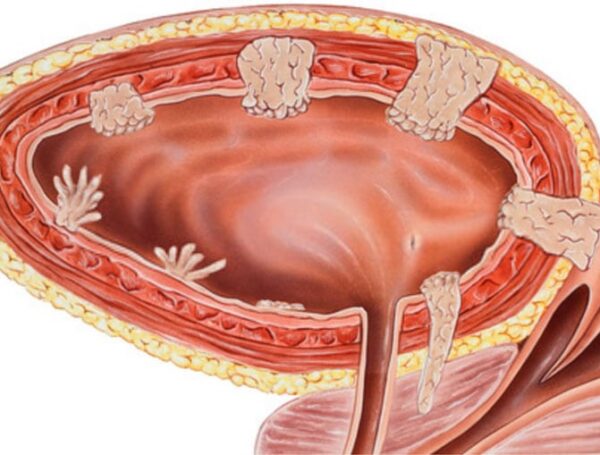 Mesane Kanseri Tedavi Yöntemleri