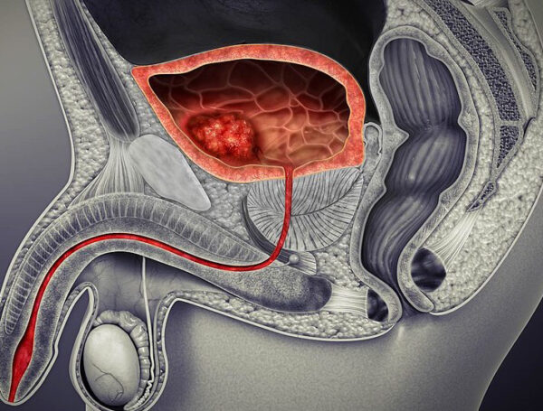 Mesane Tümörü Ameliyatı
