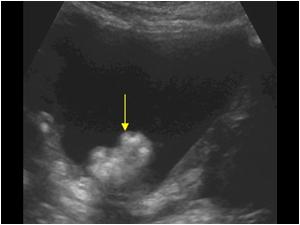 Mesanedeki Kitlenin Ultrason Görüntüsü