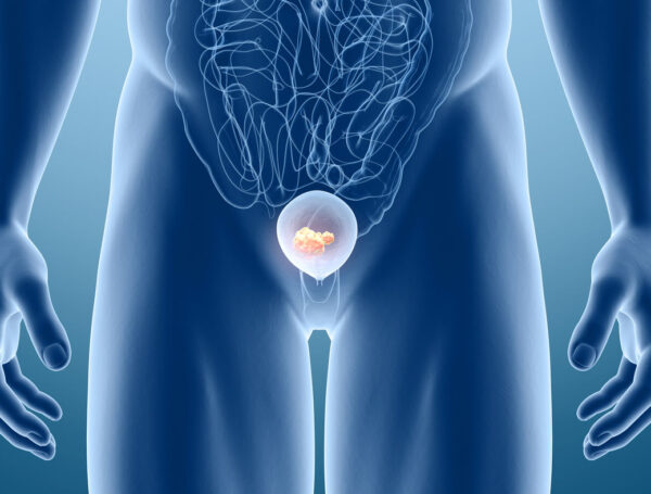 Metastatik Mesane Kanseri