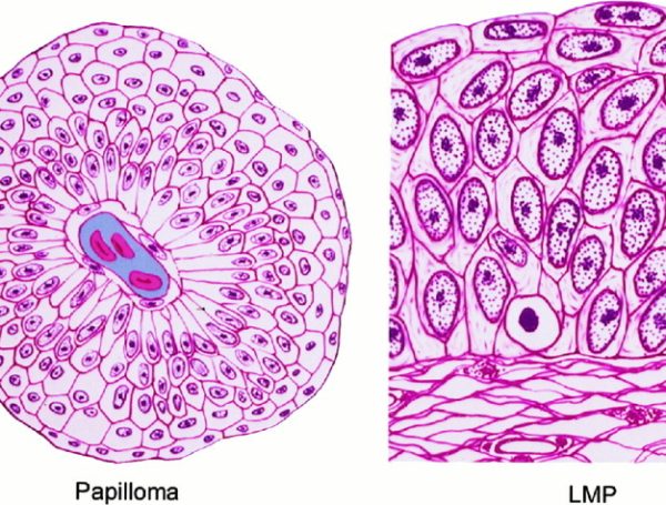 Düşük Malignite Potansiyelli Papiller Ürotelyal Neoplazi