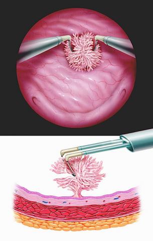 Mesane Kanseri Tedavisi-TUR-M 