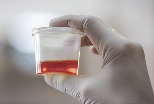 Mesane Kanserinde İdrar Ne Renk Olur?