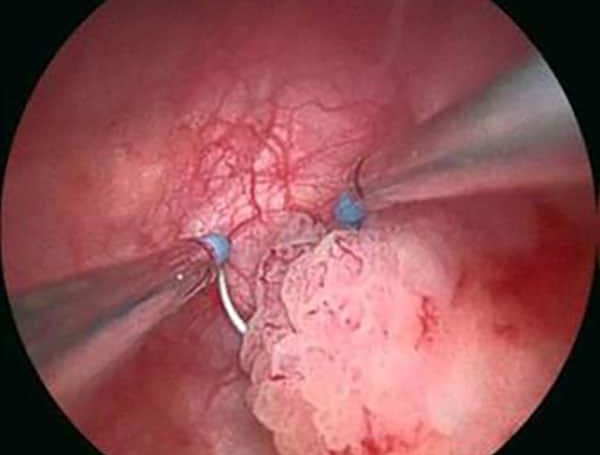 Mesane TUR Ameliyatı Sonrası Şikayetler