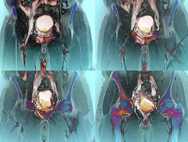 Metastatik Mesane Kanseri Tedavisi