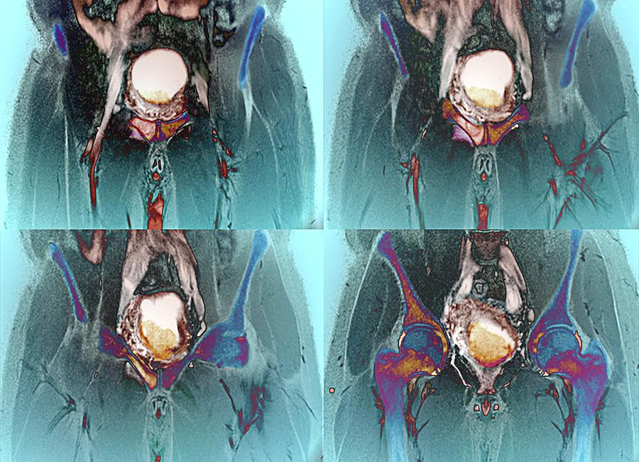 Metastatik Mesane Kanseri Tedavisi