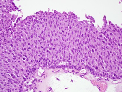 Ürotelyal Neoplazi