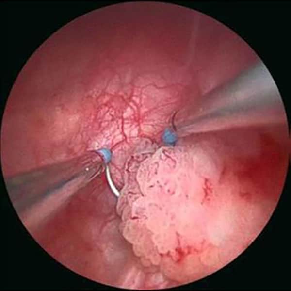 Mesane TUR Ameliyatı Sonrası Kanama