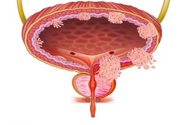 Kasa İnvaze Olmayan Mesane Kanseri