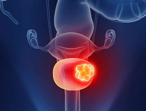 Mesane Kanseri İyileşme Oranı