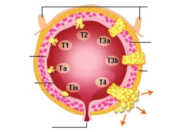 Mesane Tümörü Nasıl Yayılır? 