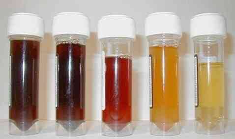 Mesane Kanserinin En Önemli Belirtisi