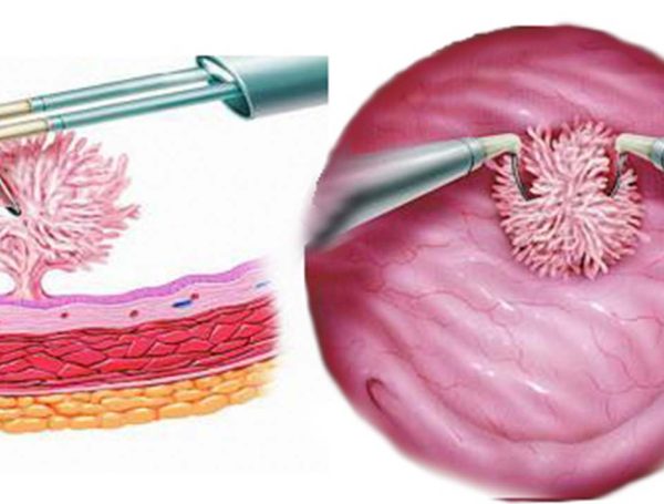 Mesane TUR Ameliyatı