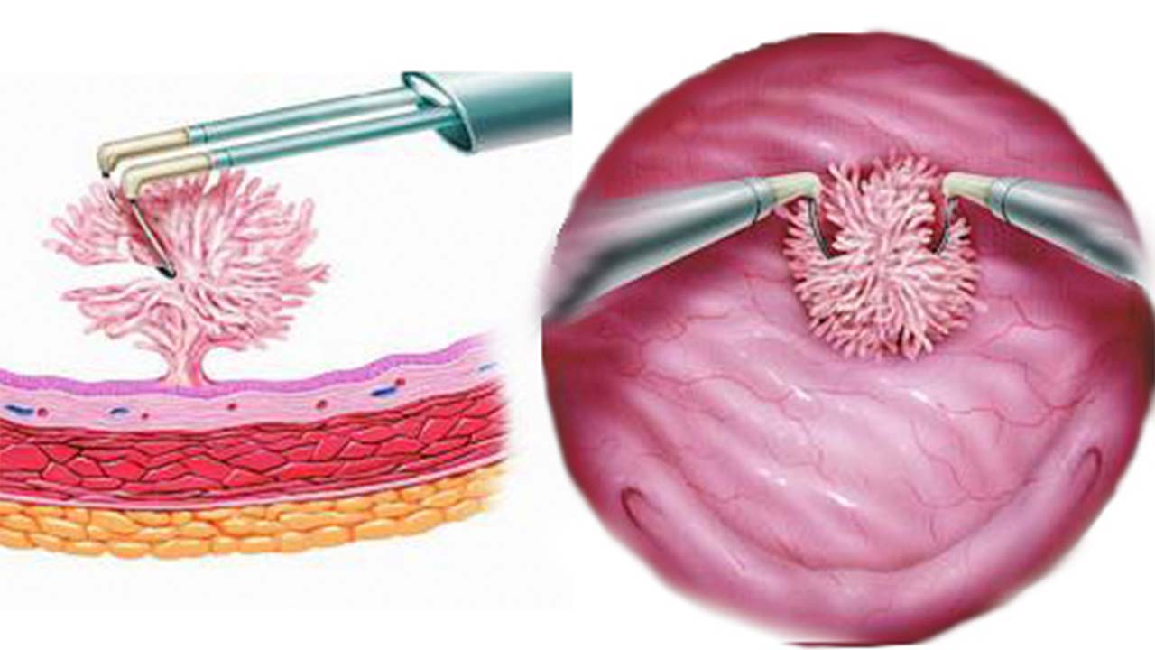 Mesane TUR Ameliyatı