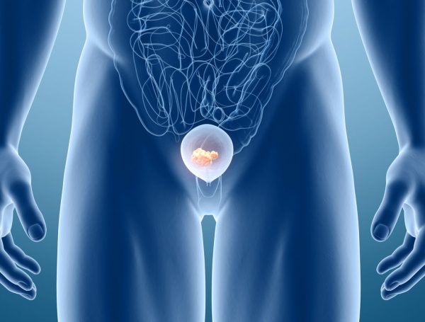 Metastatik Mesane Kanserinde Tedavi
