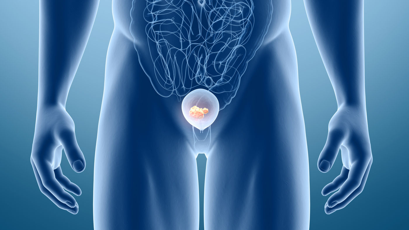 Metastatik Mesane Kanserinde Tedavi