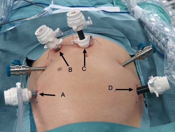 Robotik Sistektomi Ameliyatı