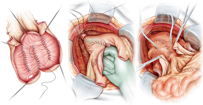 Yapay Mesane Ameliyatı Sonrası İyileşme Süreci