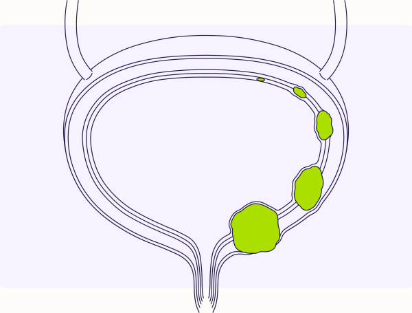 İstanbul Mesane Kanseri Tedavisi Doktorları