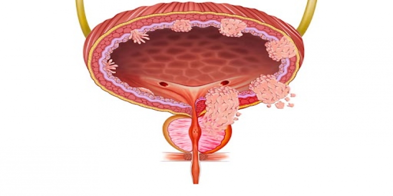 Mesane Kanseri Ameliyatı Sonrası