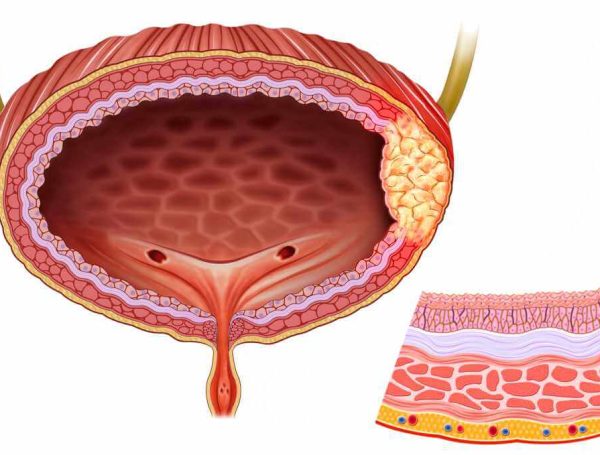 Mesane Kanseri: Belirtileri, Tanısı, Evreleme ve Tedavi