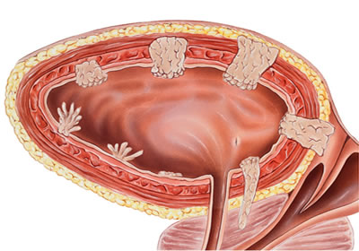 Lamina Propria İnvazyonu