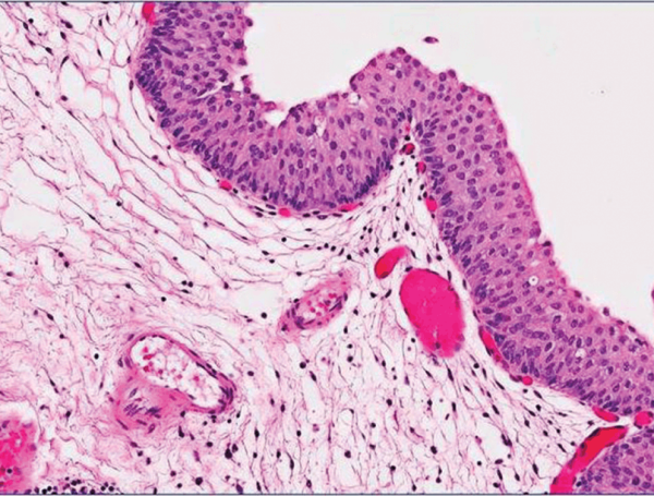 Mesane Kanseri Patoloji Raporu